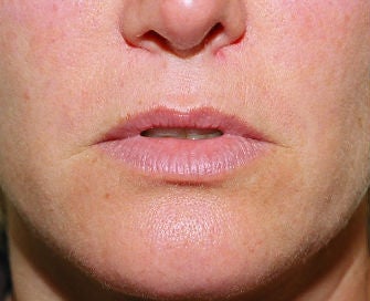 Lip lift, corner of lip lift, and filler in lips before 299914