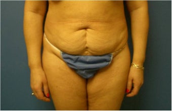 Abdominoplasty, Tummy Tuck, Liposuction before 401748