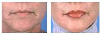Lip augmentation with Alloderm implants before 6433