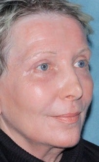 Laser resurfacing treatment for wrinkles 376154