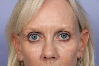 Eyelid Surgery after 306429