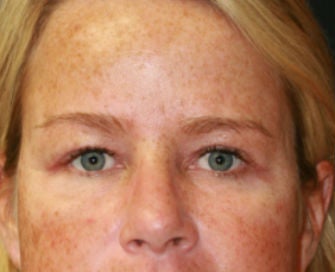Blepharoplasty after 326444