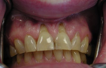 Gum lift (Crown Lengtheing), Root coverage with soft tissue Graft, before 565879