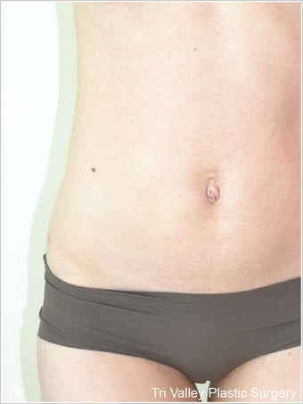 Liposuction after 420937