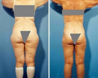 Liposuction before 636109