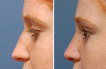 Rhinoplasty after 314278