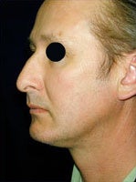Neck Lift and Fat Transfer after 84438
