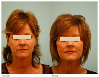 Acne Scarring Correction before 136801