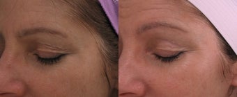 DOT Therapy before 321825
