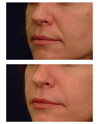 Juvederm before 82771