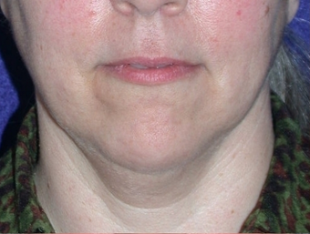 Necklift before 208456