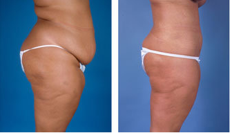 Central body lift with liposuction age 32 after 6814