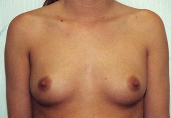 Breast Augmentation before 266791