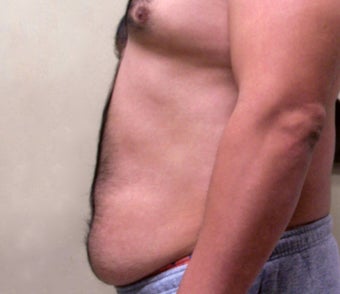 Abdominoplasty (Tummy Tuck) before 489726