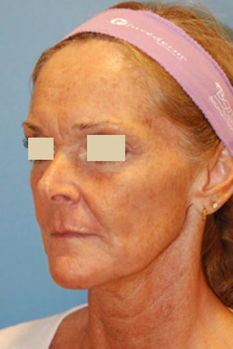Fat Transfer / Fat Grafting / YoungVolumizer Procedure before 166186