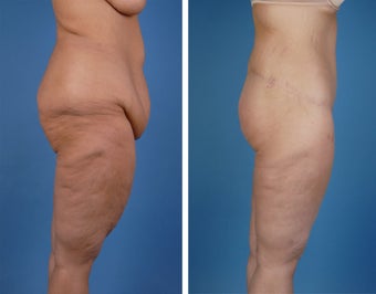 Lower Body Lift and Thighplasty 335986