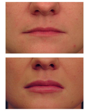 Restylane for lip augmentation before 82764