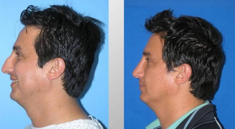 Rhinoplasty before 165808