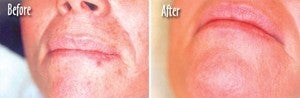 Microdermabrasion Chin and Mouth before 6394