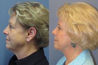 Lite Lift™, brow lift, liposuction of the nec, neck lift, blue peel after 523736