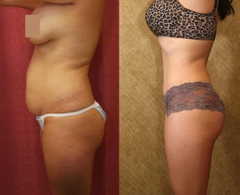 tummy tuck 637904