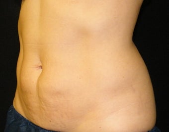 CoolSculpting 621991