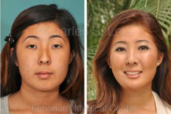 Eyelid, Nose and Chin before 427501