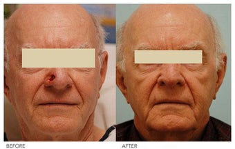 Facial Reconstruction after 136842