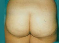 Butt lift after 375706