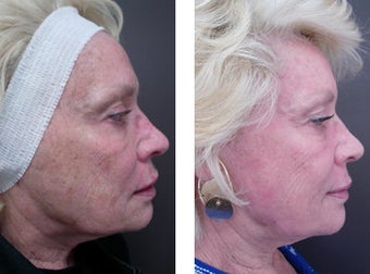 CO2 Fractional Laser before 566812