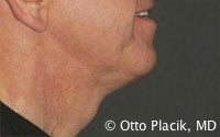 Cervicoplasty after 567302