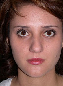 Nose Surgery, Rhinoplasty before 550008