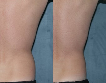 Zeltiq for fat reduction on "love handles" before 183871