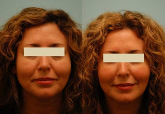 Injectable Fillers (Restylane/Perlane) before 136768