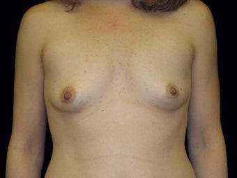 Breast augmentation before 293956