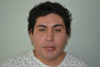 Submental Chin Liposuction 547044