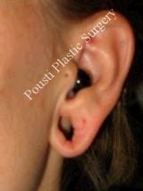 Earlobe Repair Surgery before 612304