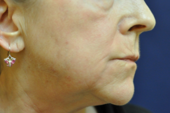Fractional C02 Laser after 594009