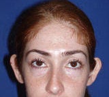 Otoplasty (Ear) Surgery before 123020