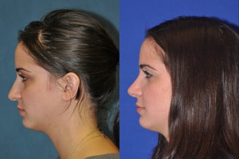 Rhinoplasty before 256040