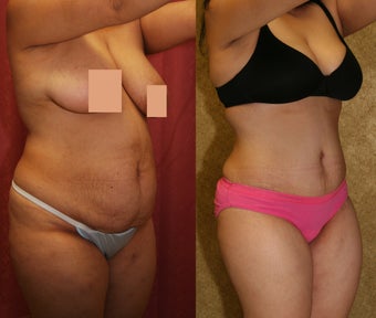 abdominoplasty- tummy tuck after 468831