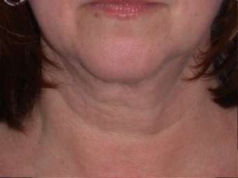 Necklift before 208441