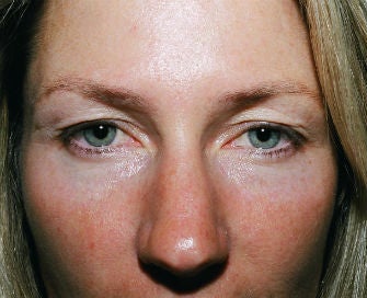 Upper eyelid blepharoplasty before 378934