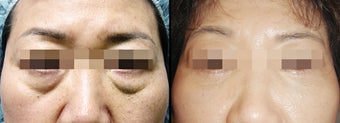 Lower Eyelid(Blepharoplasty) Surgery before 650632