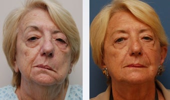 Facial Paralysis Reconstruction and Facelift before 346229