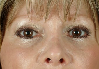 under eye fillers after 502765