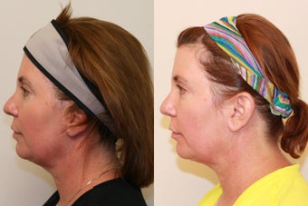 Ultherapy Lower Face before 536671