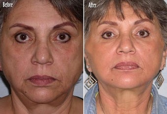 Threadlift to full face before 6821