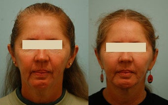 Otoplasty (Cosmetic Ear Pinning) before 136385