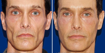 Sculptra before 496295